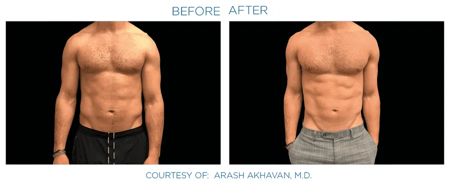 Emsculpt Neo effect on abdomen